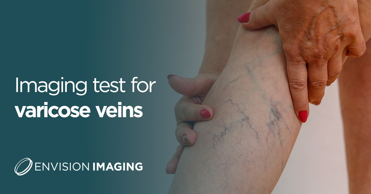 Imaging test for varicose veins