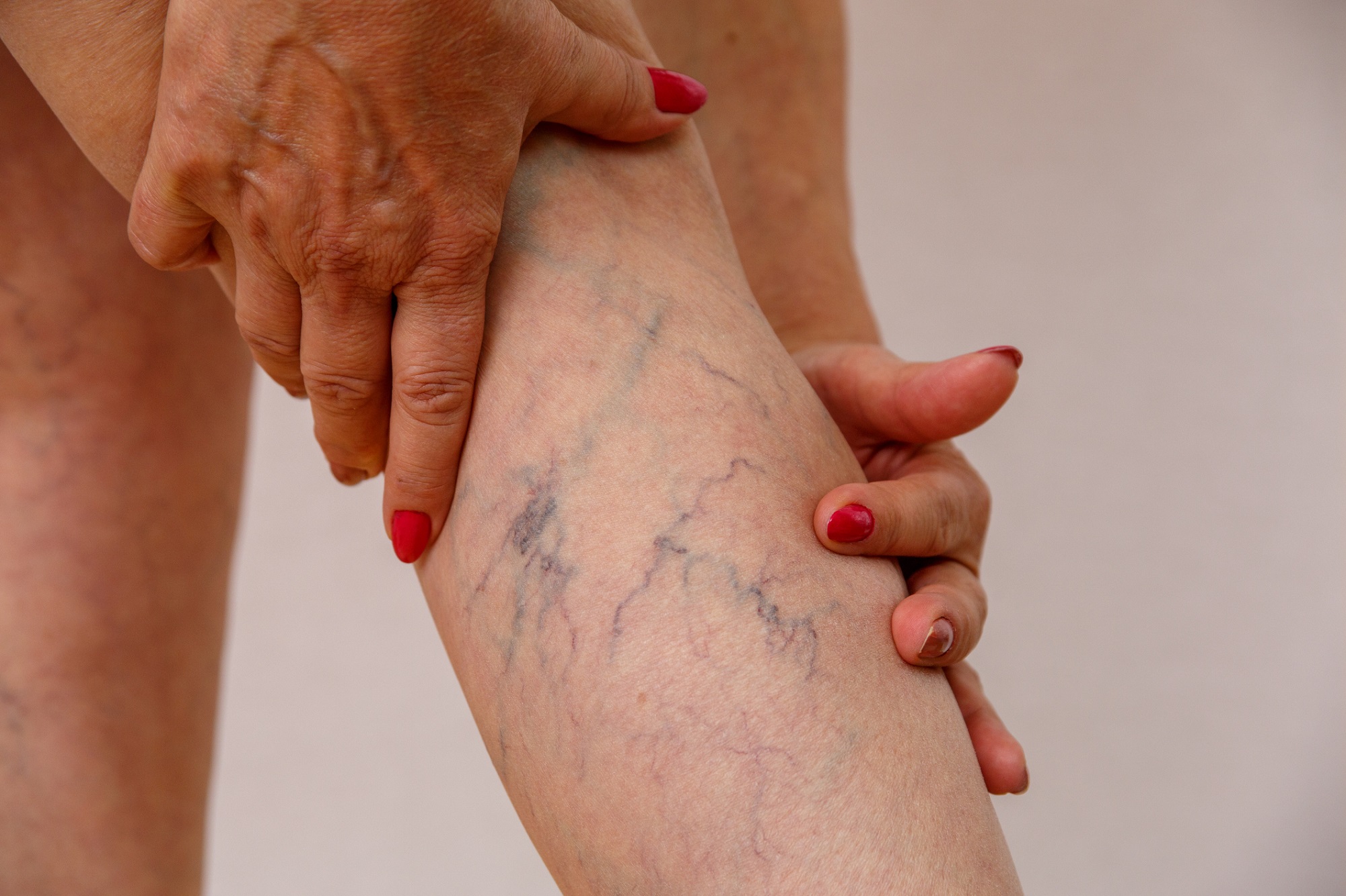 Imaging test for varicose veins